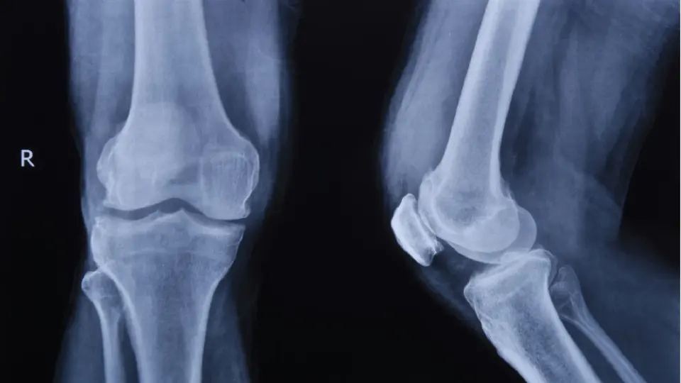 ปวดเข่า อาจไม่ใช่ “ข้อเข่าเสื่อม”