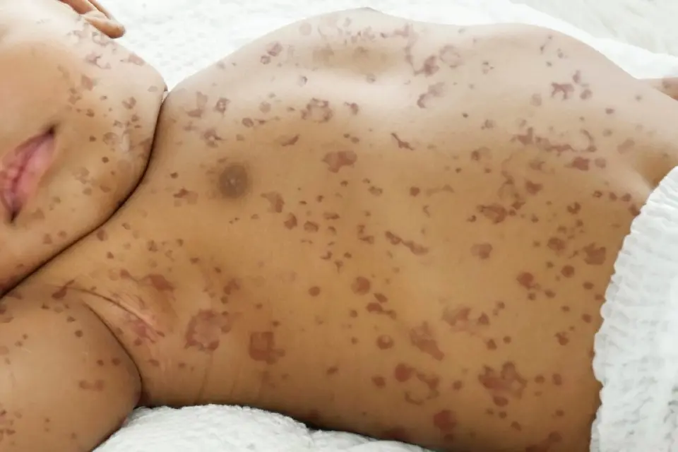 ไข้กาฬหลังแอ่น โรคติดเชื้อเฉียบพลันจากแบคทีเรีย Neisseria meningitidis 