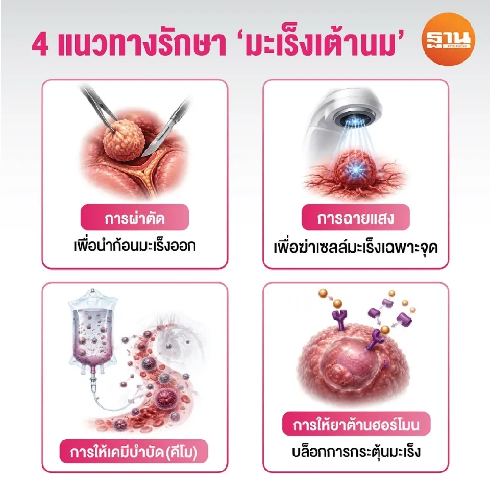 4 แนวททงการรักษา “มะเร็งเต้านม” ในปัจจุบัน
