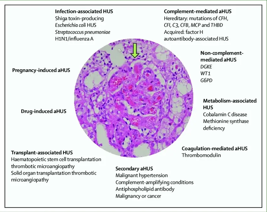 โรค aHUS หรือ Atypical Hemolytic Uremic Syndrome เป็นกลุ่มอาการหายากที่พบในเด็ก 