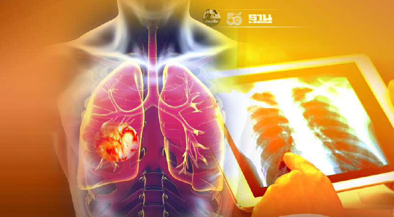 "หมอนิธิพัฒน์"ชี้ปอดอักเสบพบได้ 50% จากผู้ป่วยโควิด-นำไปสู่การตาย 1%