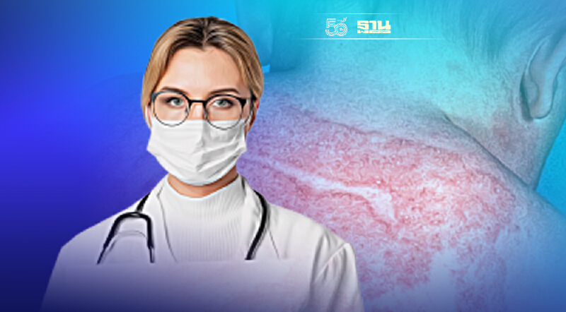 โรคผื่นภูมิแพ้ผิวหนัง รุนแรงกว่าที่คิด แนะรัฐให้สิทธิผู้ป่วยเท่าเทียมกัน