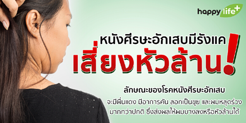 หนังศีรษะอักเสบเป็นรังแค เสี่ยงหัวล้าน หนังศีรษะอักเสบเป็นรังแค เสี่ยงหัวล้าน