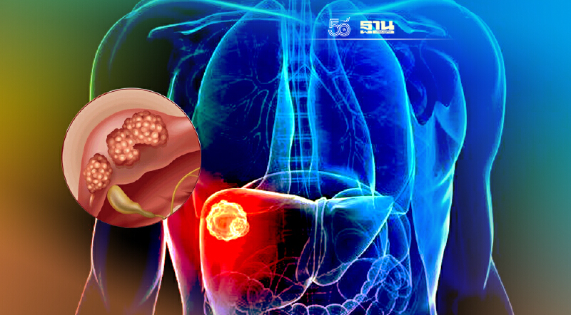 เตือนภัย"มะเร็งตับ"คร่าชีวิตคนไทยปีละกว่า 1.6 หมื่นราย