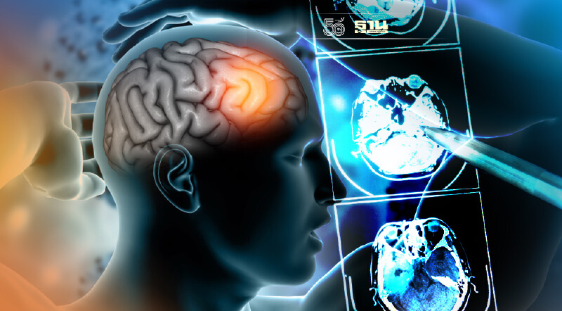 “เนื้องอกสมอง” ภัยเงียบที่ควรได้รับการวินิจฉัยและรักษาอย่างเหมาะสม