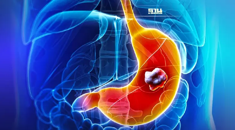 มะเร็งกระเพาะอาหาร สาเหตุ อาการ และปัจจัยเสี่ยง ...ที่เลี่ยงได้