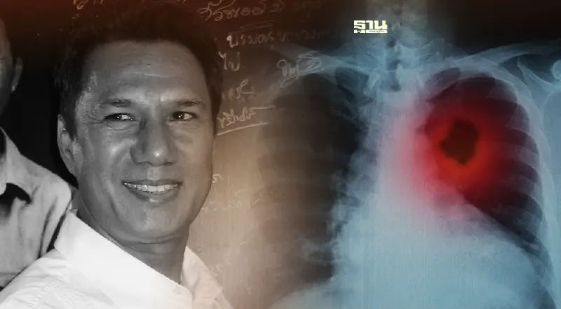 สัญญาณเตือน "มะเร็งปอด" คร่าชีวิต"สรพงษ์ ชาตรี" มีอาการเหล่านี้ต้องระวัง