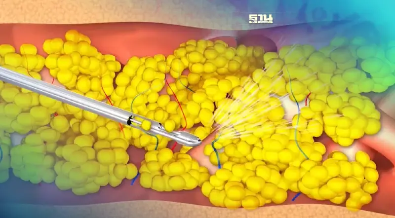 นวัตกรรม “Fat Stem Cell” เสริมพลังใจผู้ป่วยมะเร็งเต้านม