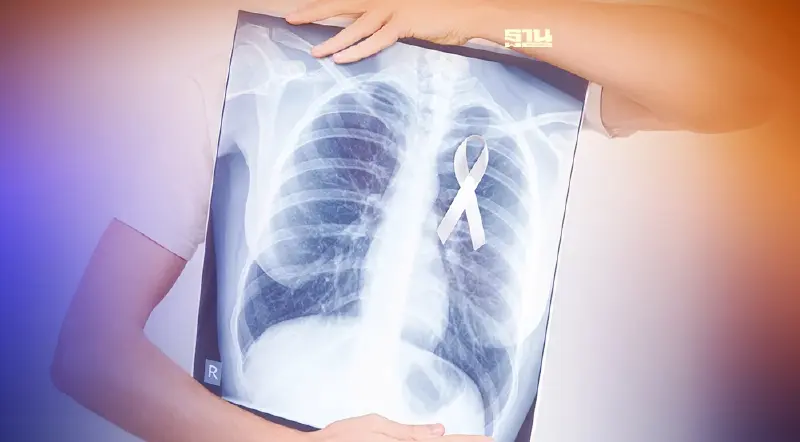 รู้ไว้ห่างไกล “มะเร็งปอด” โรคร้ายคร่า “สรพงษ์-เศรษฐา”