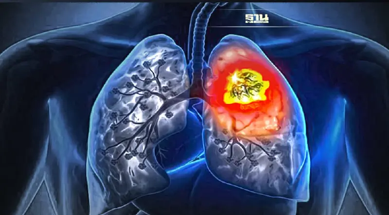 รู้จักมะเร็งปอด โรคร้ายคร่าชีวิต สรพงษ์ ชาตรี -เศรษฐา ศิระฉายา