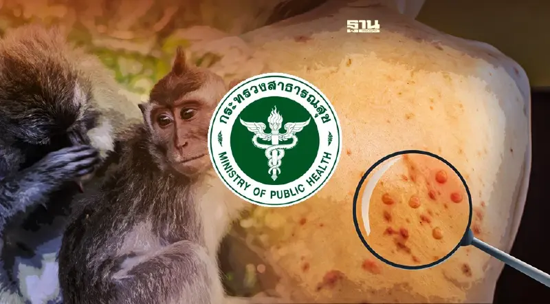 ฝีดาษลิงในไทยล่าสุด กระทรวงสาธารณสุข ติดตามผู้สัมผัสใกล้ชิด