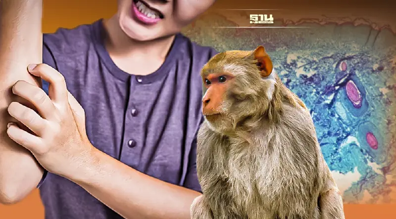 “สาธารณสุข” ยันไม่พบ “ฝีดาษลิง” ในผู้ป่วยต้องสงสัย 3 ราย