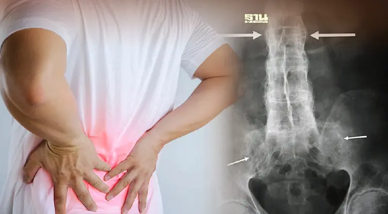ปวดหลังเรื้อรัง เช็ก 4 อาการ โรคข้อกระดูกสันหลังอักเสบชนิดติดยึด