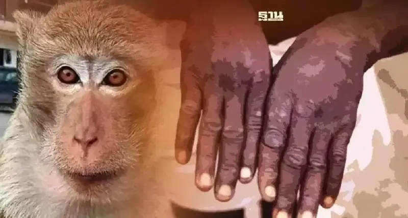 อัพเดทฝีดาษลิง ลามกว่า 20 ประเทศ ล่าสุดถึงอาร์เจนตินา รายแรกในลาตินอเมริกา