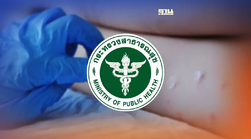 สธ.ตั้งศูนย์เฝ้าระวัง "ฝีดาษลิง" สังเกตคนเดินทางมาจากประเทศระบาด