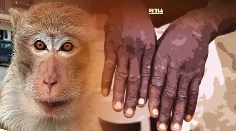 โรคฝีดาษลิง monkeypox กรมควบคุมโรคแนะวิธีป้องกัน หลังระบาดแล้ว 11 ประเทศ โรคฝีดาษลิง monkeypox กรมควบคุมโรคแนะวิธีป้องกัน หลังระบาดแล้ว 11 ประเทศ