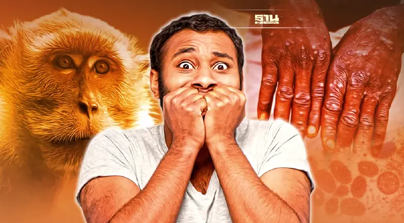 ' ฝีดาษลิง' อันตรายถึงชีวิต แนะ งดรับประทานของป่า