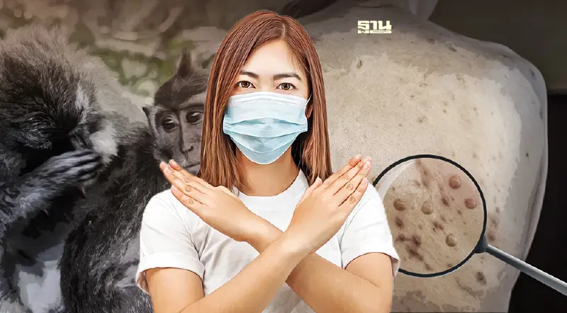 ฝีดาษลิงในไทยล่าสุดพบผู้ติดเชื้อหรือยัง เช็คข้อเท็จจริงได้ที่นี่