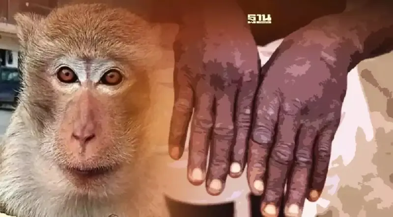 โรคฝีดาษลิง Monkeypox ล่าสุด กรมควบคุมโรค แจ้งยังไม่พบติดเชื้อในประเทศ