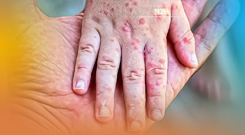 "ฝีดาษลิงในไทย" เกิดหลังปี 2523 เสี่ยงมากแค่ไหน ป้องกันตนเองอย่างไร?