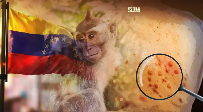 เวเนซุเอลา ยืนยันพบผู้ป่วย โรคฝีดาษลิง รายแรก เดินทางกลับจากสเปน