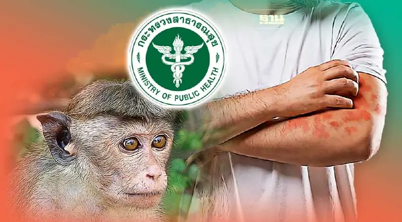 สธ. เข้ม "ฝีดาษลิง" คัดกรองผู้ป่วยใน ร.พ.- คลินิกเฉพาะ-สนามบินนานาชาติ