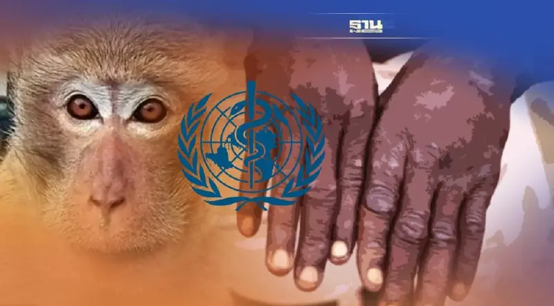 ป่วย"ฝีดาษลิง"ทะลุ 3 พันรายทั่วโลก - " WHO" เล็งประกาศภาวะฉุกเฉิน