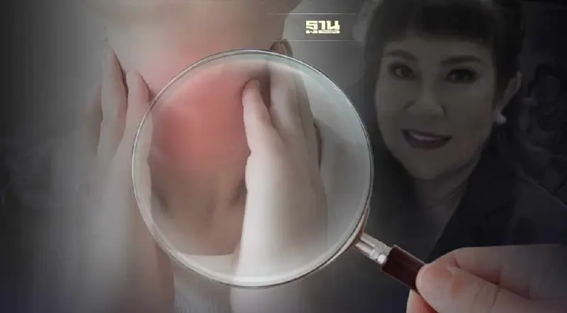 วิธีสังเกตอาการ มะเร็งต่อมน้ำเหลือง โรคร้ายคร่าชีวิต “อิ๋งอิ๋ง” พิธีกรดัง