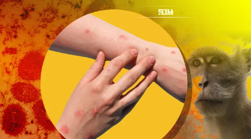 'โรคฝีดาษลิง' โรคระบาดใหม่ ที่ไม่ควรมองข้าม แต่ป้องกันได้!