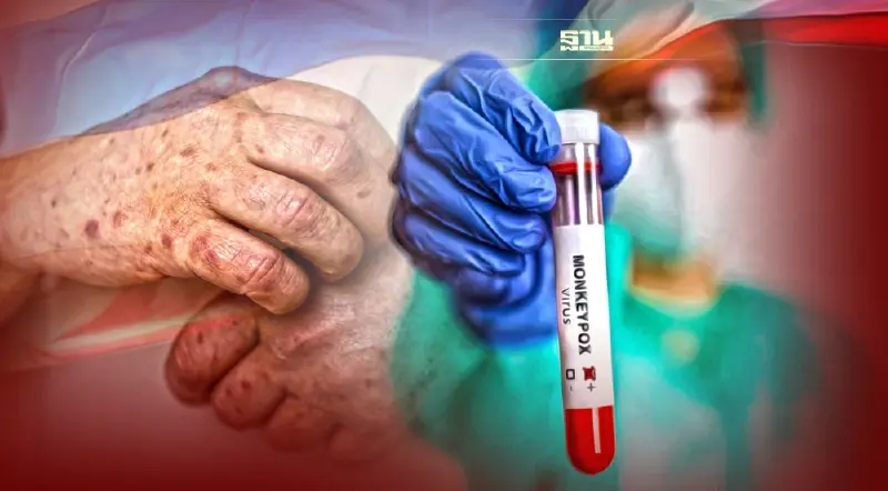 เปิดไทม์ไลน์ผู้ป่วย"โรคฝีดาษลิง"รายแรกในไทย