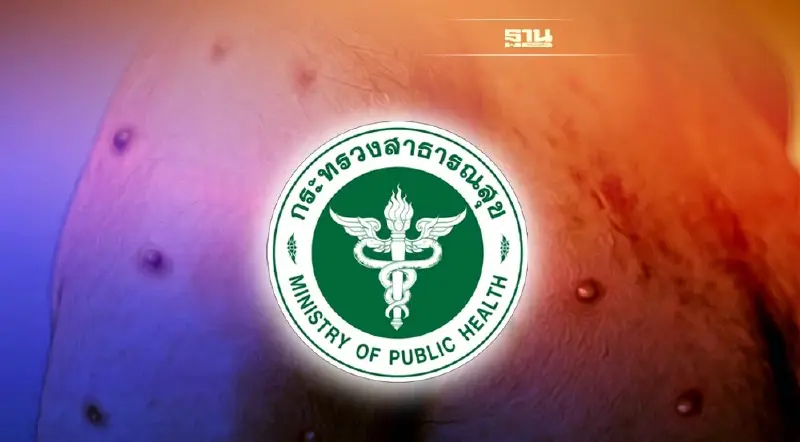 สธ.เร่งตามตัวชายยุโรป คาดต้นตอแพร่โรคฝีดาษลิง