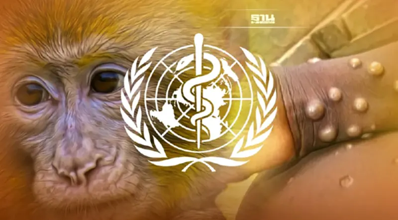 WHO เรียกร้องยุโรปเร่งสกัด'ฝีดาษลิง' หลังพบผู้ติดเชื้อเพิ่ม3เท่า WHO เรียกร้องยุโรปเร่งสกัด'ฝีดาษลิง' หลังพบผู้ติดเชื้อเพิ่ม3เท่า