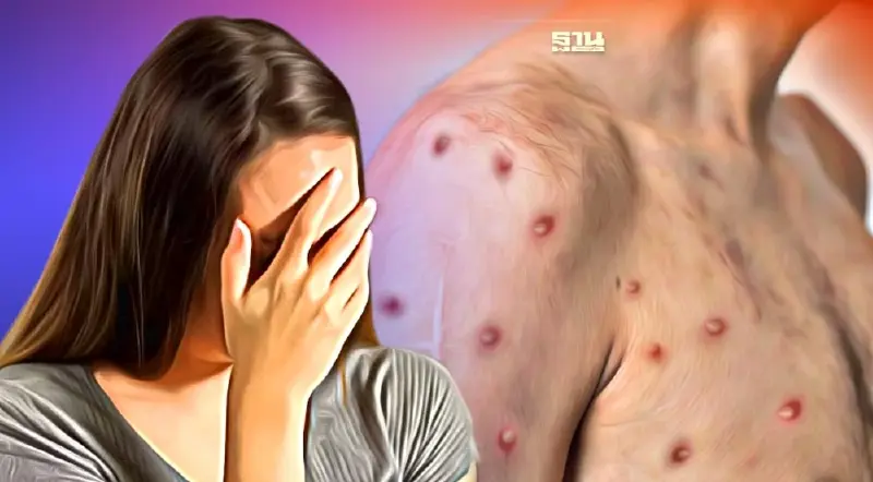 เช็คอาการ “ฝีดาษลิง” ตุ่มแบบไหนใช่ พร้อมวิธีป้องกันตนเอง