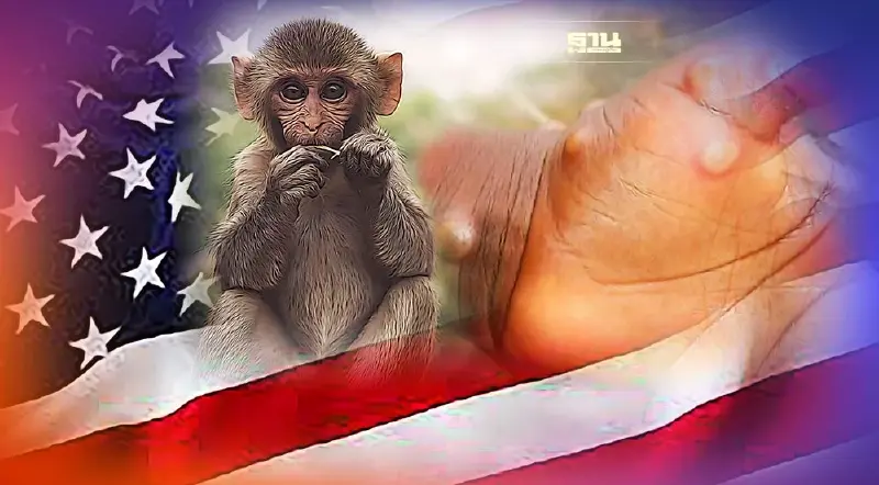 สหรัฐฯ คาดป่วย “ฝีดาษลิง Monkeypox” พุ่งต่อเนื่องถึงสิงหาคม