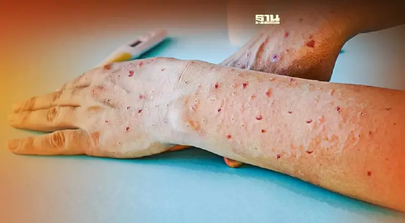 ทำความรู้จัก “ไข้หวัดมะเขือเทศ” หลังระบาดในอินเดีย