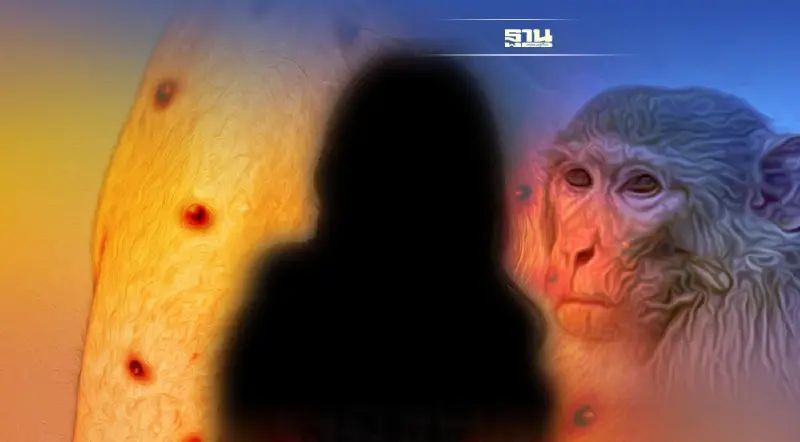 "ฝีดาษลิง" ใครบ้างติดเชื้อแล้วเสี่ยงอาการรุนแรง เช็คเลย