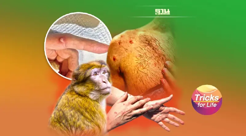 อัพเดท‘ฝีดาษลิง’ มีอาการเช่นไร ป้องกัน รักษาอย่างไร