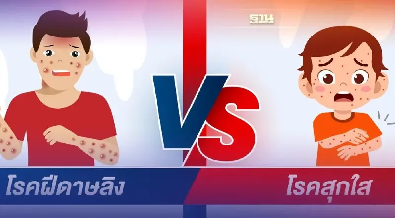 “ฝีดาษลิง กับ โรคอีสุกอีใส” ลักษณะอาการต่างกันอย่างไรอ่านด่วนที่นี่