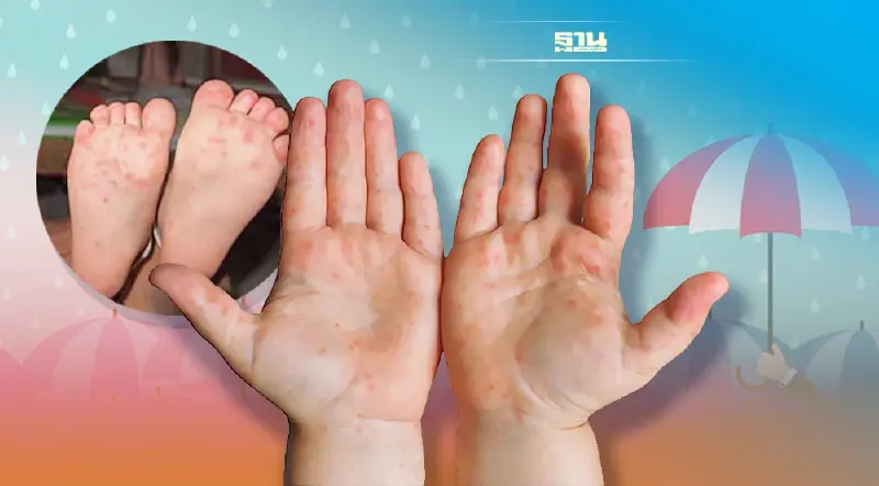 'โรคมือเท้าปาก' ที่มาพร้อมหน้าฝน' ถ้าเด็กเป็นแล้ว ต้องรักษาอย่างไร?