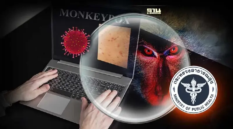 จับตา สธ. เคาะแนวทางรักษา “ฝีดาษลิง”1 ส.ค.นี้