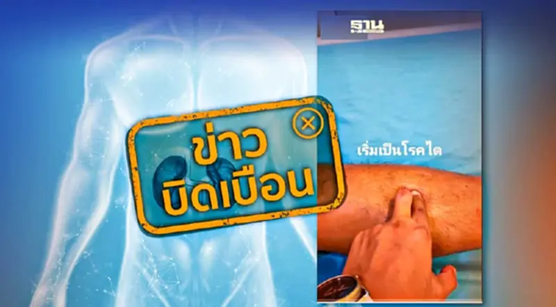 ข่าวบิดเบือน ใช้นิ้วมือกดบริเวณขาเช็กอาการเริ่มเป็นโรคไต ข่าวบิดเบือน ใช้นิ้วมือกดบริเวณขาเช็กอาการเริ่มเป็นโรคไต