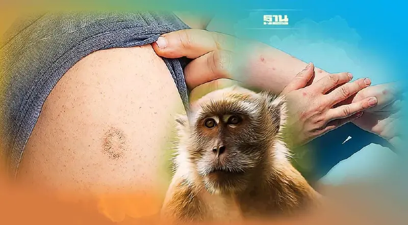 ข่าวดี! ปลูกฝีไข้ทรพิษกัน "ฝีดาษลิง" ได้ ภูมิอยู่นาน 88 ปี