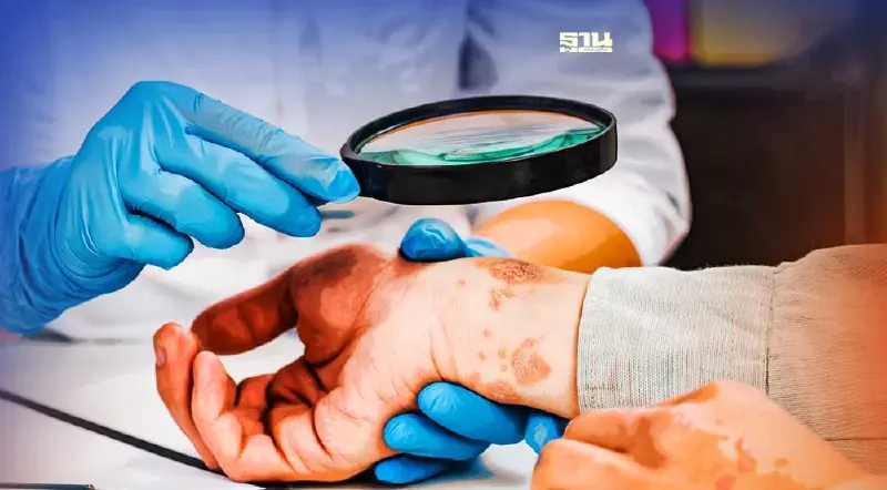 อาการทางผิวหนัง สัญญาณบ่งชี้โรคทางกายอะไรได้บ้าง