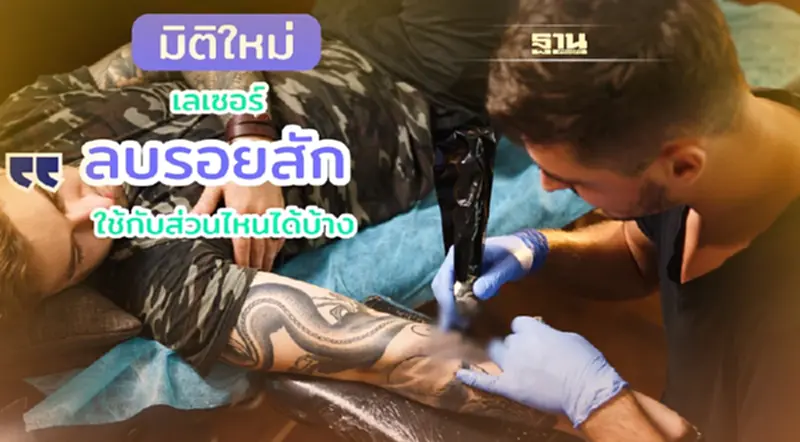 เลเซอร์ลบรอยสักมีหลักการทำงานอย่างไร? ทำไมถึงไม่ทิ้งรอยแผลเป็นหลังทำ? เลเซอร์ลบรอยสักมีหลักการทำงานอย่างไร? ทำไมถึงไม่ทิ้งรอยแผลเป็นหลังทำ?