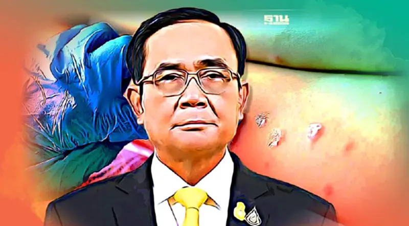 “นายกฯ” สั่งคุมเข้ม การระบาด “ฝีดาษลิง” คาดวัคซีนถึงไทยปลายส.ค.นี้ “นายกฯ” สั่งคุมเข้ม การระบาด “ฝีดาษลิง” คาดวัคซีนถึงไทยปลายส.ค.นี้