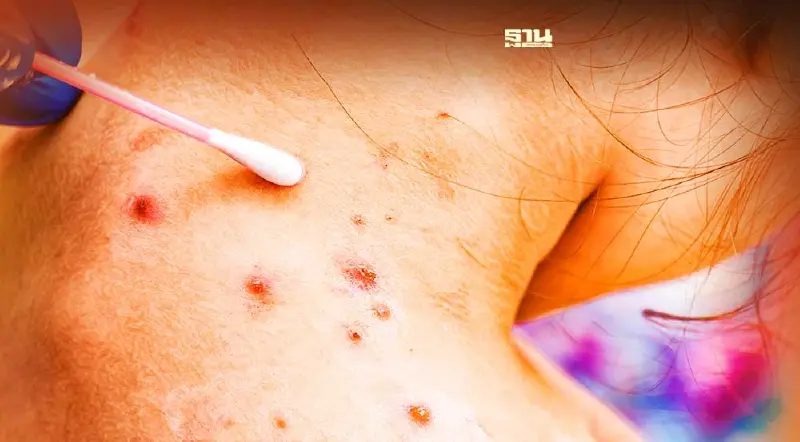 “อีสุกอีใส” ภัยร้าย อย่าชะล่าใจ อันตรายถึงชีวิต