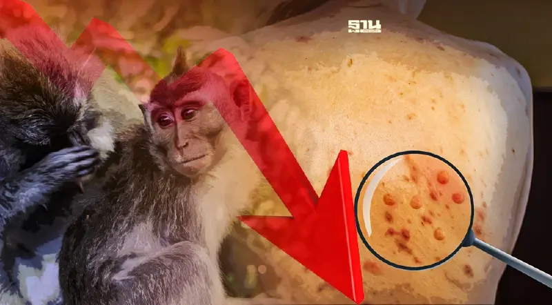 ฝีดาษลิงขาลง "สาธารณสุข" ปรับระดับศูนย์ EOC เป็น ระดับกรม 