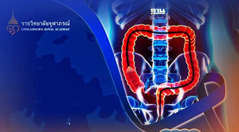 ราชวิทยาลัยจุฬาภรณ์ รับอาสาสมัครตรวจมะเร็งลำไส้ใหญ่ ฟรี 500 คน 