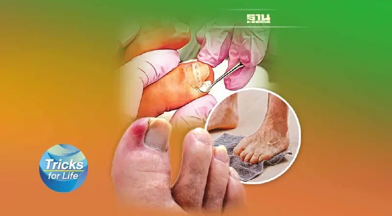 ‘เล็บขบ’ เรื่องเล็กๆ ที่ไม่อาจมองข้าม