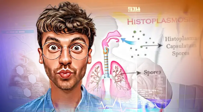 โรคฮิสโตพลาสโมซิสคืออะไร อาการยังไง น่ากลัวแค่ไหน เช็คเลย